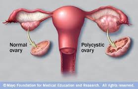 Hair loss in women; Polycystic Ovarian Syndrome (PCOS):