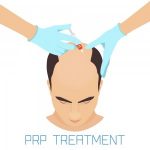 PRP for Hair Loss